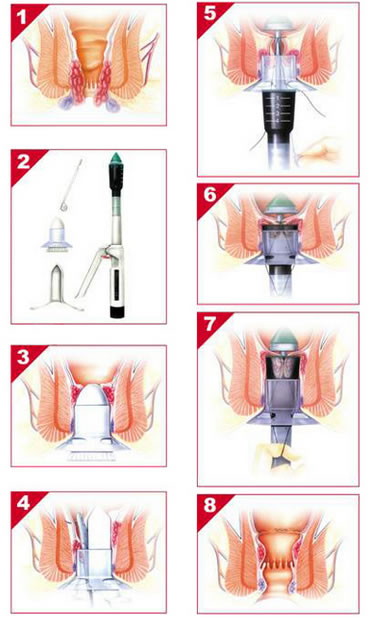 痔瘡槍手術治療的過程，總共有8張圖片，當中以透視形式描述如何使用痔瘡槍脫痔。