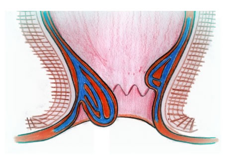 肛門痔瘡透視的插圖