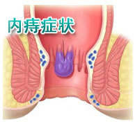 透視的肛門插畫圖片，圖中寫著內痔症狀，同時有一條黑色線條指著痔瘡的位置。