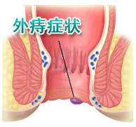 透視的肛門插畫圖片，圖中寫著外痔症狀，同時有一條黑色線條指著痔瘡的位置。