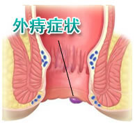 透視的肛門插畫圖片,圖中寫著外痔症狀,同時有一條黑色線條指著痔瘡的位置。