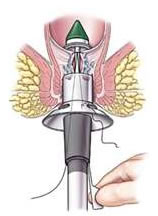 痔瘡槍手術的插畫描述圖，圖片中有一個組手術器械放進肛門中。