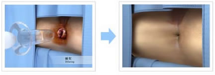 超聲波無刀除痔的過程圖片，一共有兩張圖片，圖一是無刀除痔的過程，圖二是手術後的肛門。
