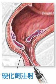 圖中有一枝針筒注射硬化劑到肛門裏的痔瘡，圖下方寫著硬化劑注射。