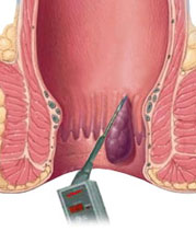 痔瘡溶解術的插畫描述圖。